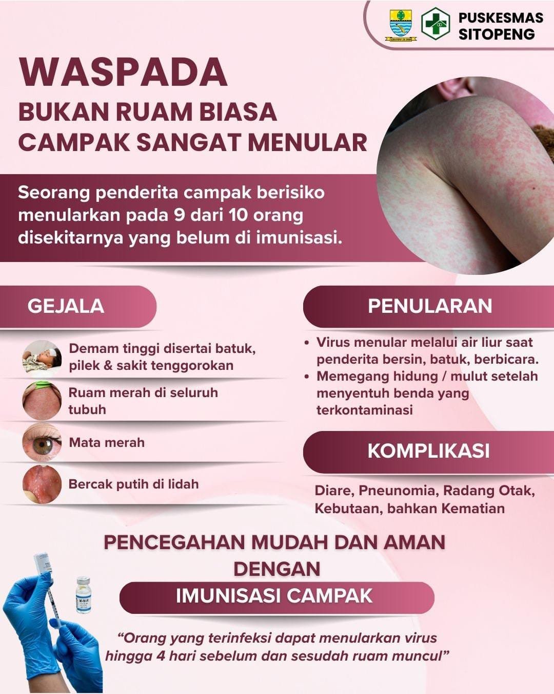 Waspada Bukan Ruam Biasa, Campak Sangat Menular